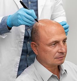 Hair-Transplant-Aesthetically-Pleasing-Results