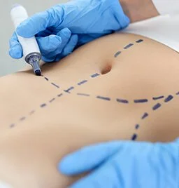 Liposuction-Expertise